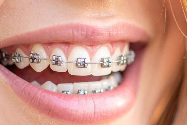 Orthodontic Treatments