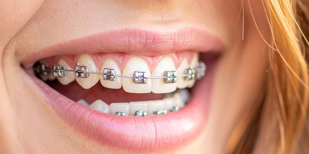 Orthodontic Treatments