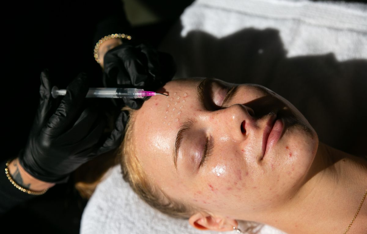 Benefits of Jessner Peels for Skin Renewal